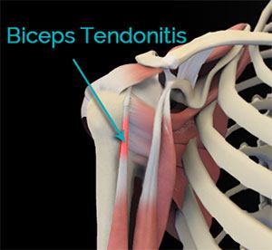 Posterolateral Instability