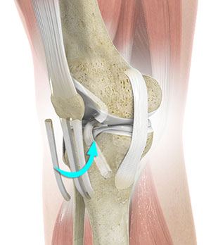 Posterolateral Instability