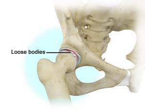 Loose Bodies in the Knee