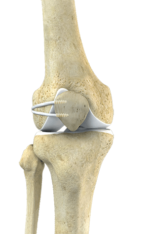 LPFL Reconstruction