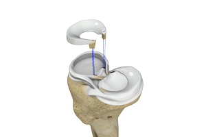 Meniscal Transplantation