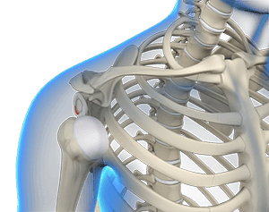 Multidirectional Instability of the Shoulder