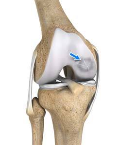 Osteochondritis Dissecans of the Knee