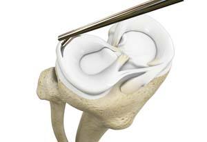 Distal Realignment Procedures