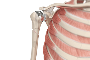 Proximal Biceps Tenodesis