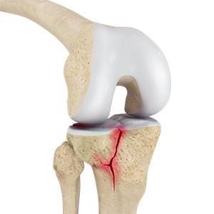 Posterolateral Instability